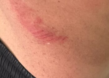 Ataque con piedras en el río: un nadador denuncia que fue herido