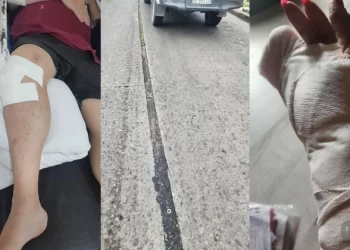 Grave accidente por una grieta en la calle: una pareja cayó de la moto, sufrió fracturas y necesita una cirugía urgente
